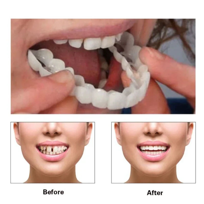 Denture Cover Veneer Snap-on T - Teeth Whitening Kit 评论和价格