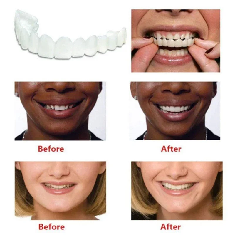 Denture Cover Veneer Snap-on T - Teeth Whitening Kit 评论和价格